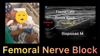 Femoral Nerve Block  Ultrasound Guided [upl. by Aerdnaid]