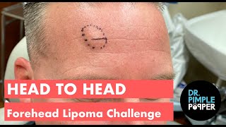 Head to Head Forehead Lipomas Challenge  Challenger 1 [upl. by Baudelaire]