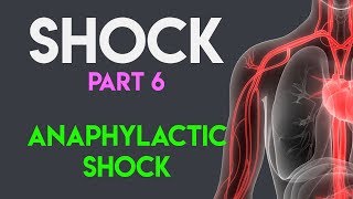 Anaphylactic Shock  Shock Part 6 [upl. by Trinl]