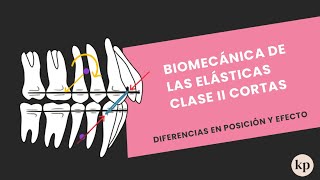 Biomecánica de las Elásticas Clase II Cortas en Ortodoncia Rotación Sincrónica y Asíncrona [upl. by Yelyah434]