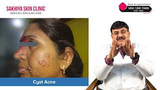 Effective Treatment for Cyst  सिस्ट का इलाज  Expert Solutions by Dr Jagdish Sakhiya [upl. by Arrej]