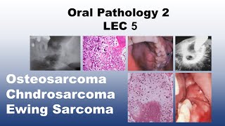 Oral Pathology 2  LEC 5  Osteosarcoma and Chndrosarcoma and Ewing Sarcoma [upl. by Temple922]