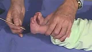 321  Reflexes Plantar Reflex  Newborn Normal  Infant Clinical ExaminationMRCP [upl. by Condon]