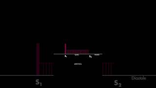 Holosystolic murmur [upl. by Aterg]