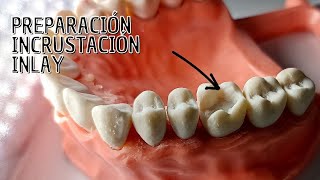 Preparación Incrustación dental Inlay [upl. by Shurwood]