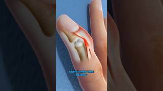 What is mallet finger 3D Animation [upl. by Jamill]