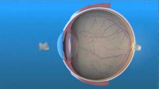 Intraocular Lens IOL [upl. by Ahsaekal205]