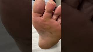 Dive into the world of foot care with Australias top podiatrist Dont miss this callus removal rev [upl. by Yeffej416]