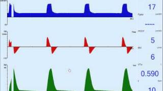 Patient Ventilator Asynchrony Double trigger [upl. by Yenroc]