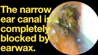 The narrow ear canal is completely blocked by earwaxear wax removal  ear cleaning  ASMR [upl. by Dominus]