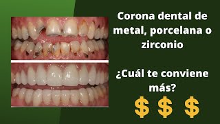 ¿Necesitas una corona dental ¿Cuánto cuesta 2022 [upl. by Ingunna226]