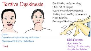 Tardive dyskinesia Causes Symptoms and Treatment [upl. by Ardle]