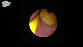 Localization of the ureter stone [upl. by Steele538]