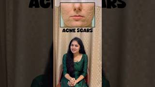 Acne scars treatment For bookings 📞859785850 acne acnescars [upl. by Annauqal879]