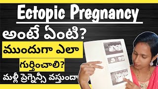 ectopic pregnancy in Telugu ectopicpregnancy pregnancy pregnant pcos pcod pcoddiet thyroid [upl. by Wahlstrom]