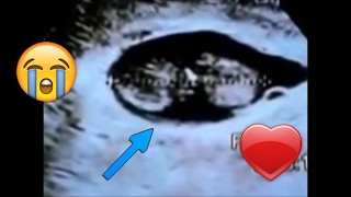 Baby diagnosed DEAD at 8 12 weeks pregnant via Ultrasound Miscarriage DampC Needed [upl. by Olfe]