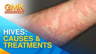 Cause and treatment for urticaria or hives  Usapang Pangkalusugan [upl. by Etnaik]