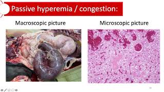 Hyperemia and congestion [upl. by Lashonde174]