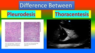 Difference Between Pleurodesis and Thoracentesis [upl. by Alliehs6]