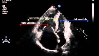 8B Apical four chamber view pulmonary hypertension [upl. by Eidob]