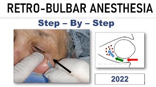Retrobulbar Block  21 [upl. by Rubi910]