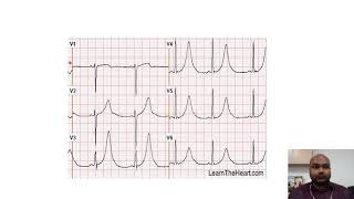 ECG Interpretation 9 T Wave Morphology [upl. by Akined]