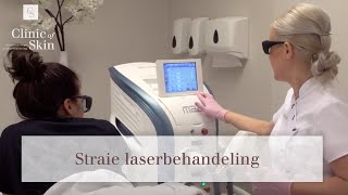 Striae laserbehandeling [upl. by Guillaume]