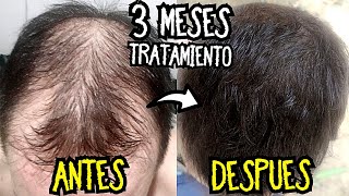 Recuperar el CABELLO en 3 MESES ¡RESULTADOS TRATAMIENTO Calvicie  Minoxidil Antes y Despues [upl. by Bohaty]