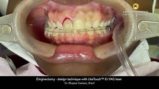 Gingivectomy  design technique with LiteTouch™ ErYAG laser [upl. by Callista257]