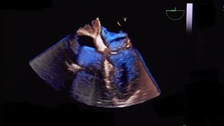 Lipomatous hypertrophy of the atrial septum LHAS [upl. by Townie]