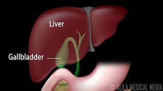 Gallstones and Surgical Removal of Gallbladder Cholecystectomy Animation [upl. by Oswin93]