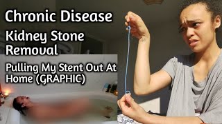 PULLING OUT MY OWN STENT  Kidney Stone Removal amp Recovery Graphic [upl. by Cindy371]