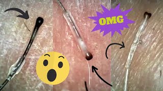 Ingrown Hair Removal  Roots and Sheaths Hair Plucks Under the Microscope Super Satisfying [upl. by Hasin809]