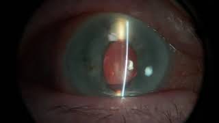 Examination of a corneal ulcer plus more [upl. by Nolrev]