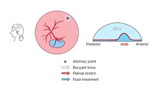 Views of the Mechanism of Retinal Displacement Following Pars Plana Vitrectomy [upl. by Ataynek]