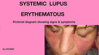 Systemic LUPUS ERYTHEMATOUS [upl. by Avehstab]