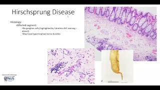 Colon Hirschsprung disease [upl. by Garneau73]