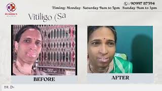 Restoring Pigment Effective Treatment for Vitiligo at Dr Danial’s Clinic [upl. by Ressan66]