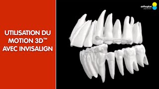 Concept Carriere®  Comment allier Motion 3D™ et alignement avec Invisalign [upl. by Llemij142]