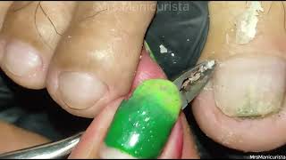 Toenail Ingrown Removal meron naman palang nakatago [upl. by Atima]