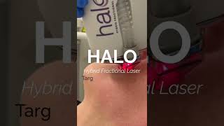 Halo  Hybrid Fractional Laser  LampP Aesthetics  Bay Areas Best Medical Spa [upl. by Oakleil]