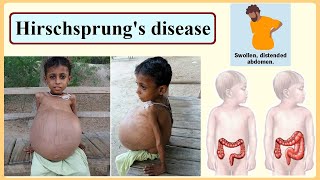 Hirschsprungs disease [upl. by Yvette]