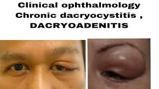 Clinical ophthalmology chronic dacryocystitis DACRYOADENITIS acute and chronic in easiest way [upl. by Aroled]