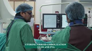 Uterine Fibroid Embolization Glue and PVA  IRFACILITIES [upl. by Hinze]