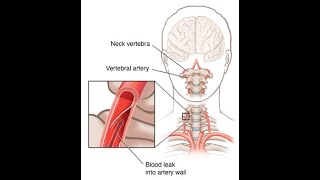 Applied or clinical anatomy of vertebral artery  Occlusion to branches of vertebral artery [upl. by Jeromy]