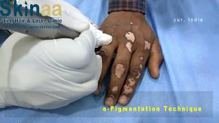 Vitiligo or Leucoderma Treatment Micropigmentation in India  Safed Daag Ka Ilaj │Skinaa Clinic [upl. by Onitsoga]