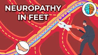 Dealing with Neuropathy in Feet Causes Symptoms and Treatments [upl. by Samale]