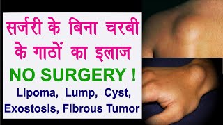 Lipoma Without Surgery चरबी के गाठों का इलाज  Fat Lump Fibrous Tumor Exostosis Cyst Ganglion [upl. by Sewell]