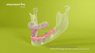 Straumann® Pro Arch US Version [upl. by Lleznol]