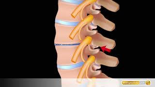 Spondylose der Wirbelsäule mit Schäden an Facettengelenken und Bandscheiben [upl. by Oberg992]